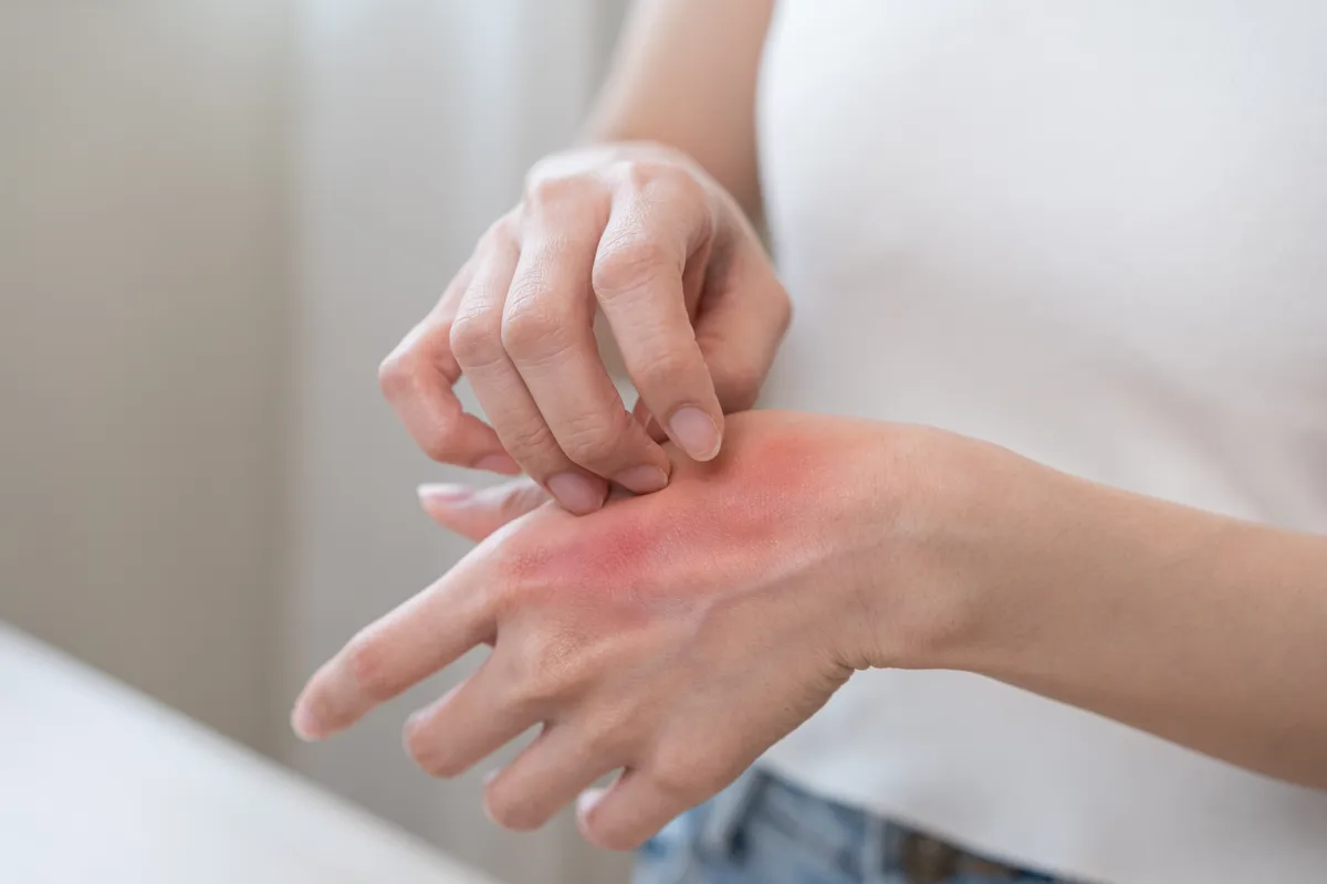 Női kéz ami sebes a karácsonyfa-szindróma miatt.