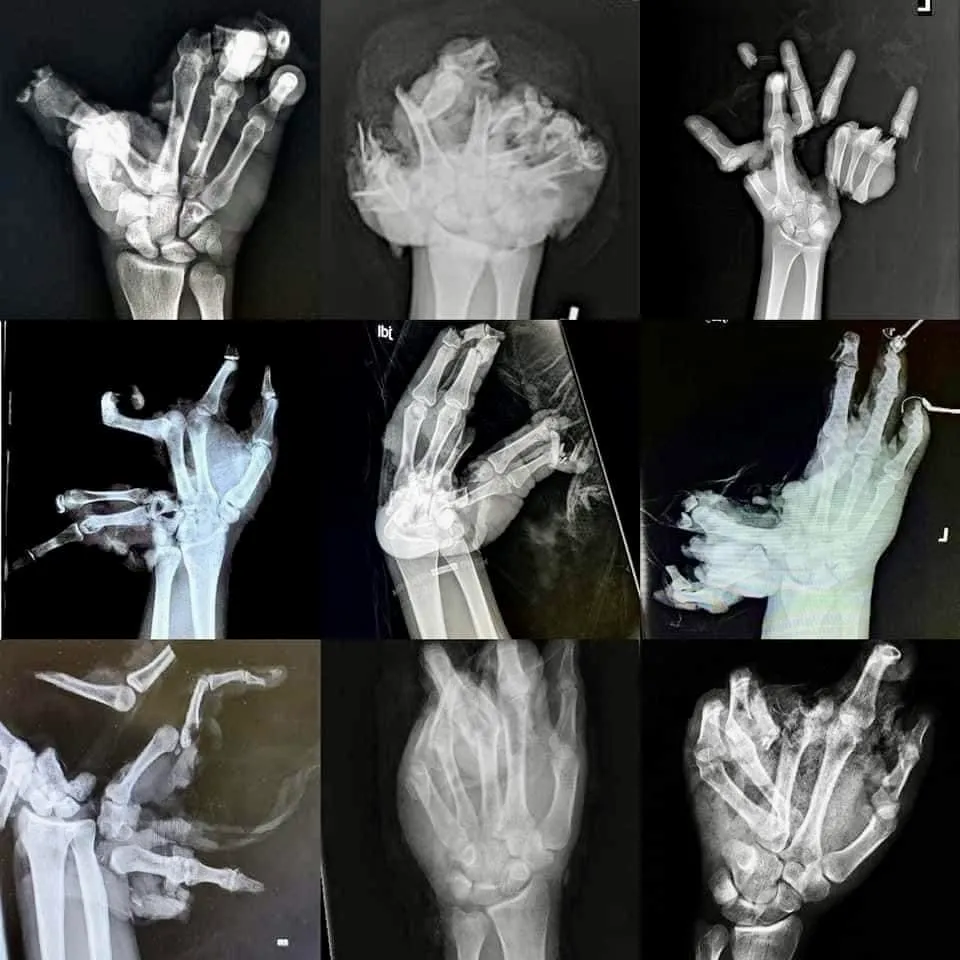 Szilveszteri bulin roncsolódott kezek röntgenfelvétele