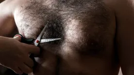 Vérfarkas szindróma – Az abnormális szőrnövekedés betegsége