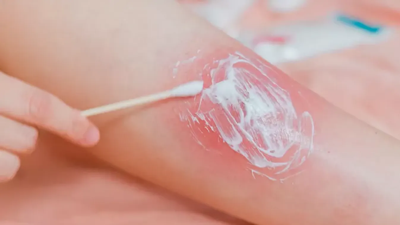 Emlékszel a pattanásnyomkodó videók királyára? Tudj meg mindent a furunkulusról