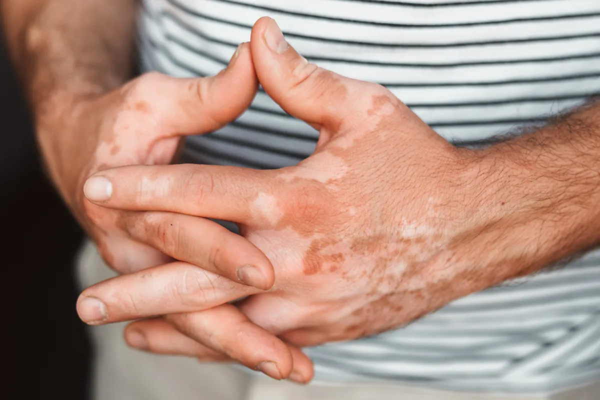 Hands,With,Vitiligo,Skin,Pigmentation,Close-up,With,His,Shirt,As