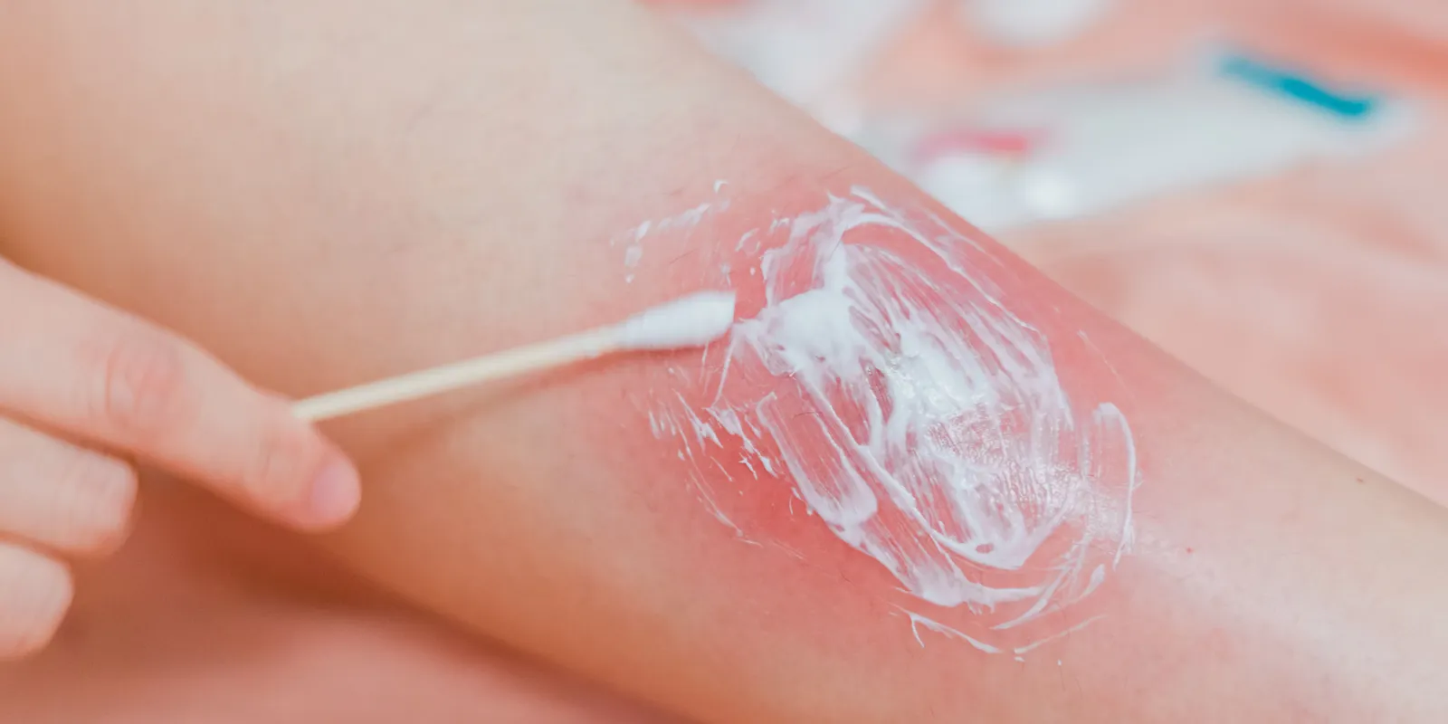 Rémlik a pattanásos videók királya? Minden a furunkulusról