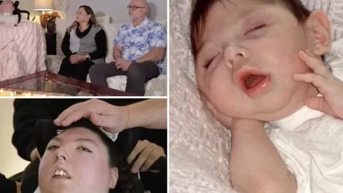 Agy nélkül született Alex, ritka betegség foglya