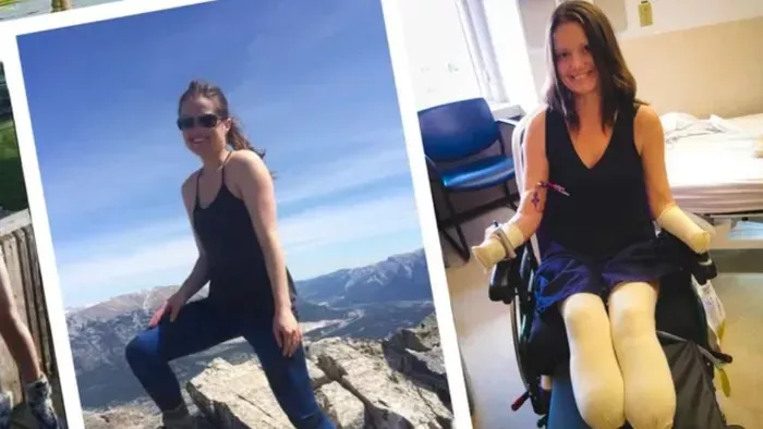 Néma gyilkos miatt veszítette el a nő mind a négy végtagját