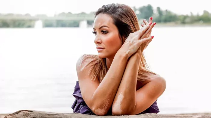 A vitiligós emberekért harcol Széles Adrienn