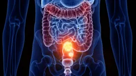 Vastagbélrák: a csendes gyilkos, amit egy egyszerű vizsgálattal megelőzhetsz