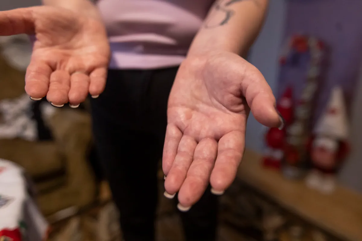 Munkahelyi baleset miatt lebénult az egyik keze, tönkrement az asszony élete
 Bélapátfalva