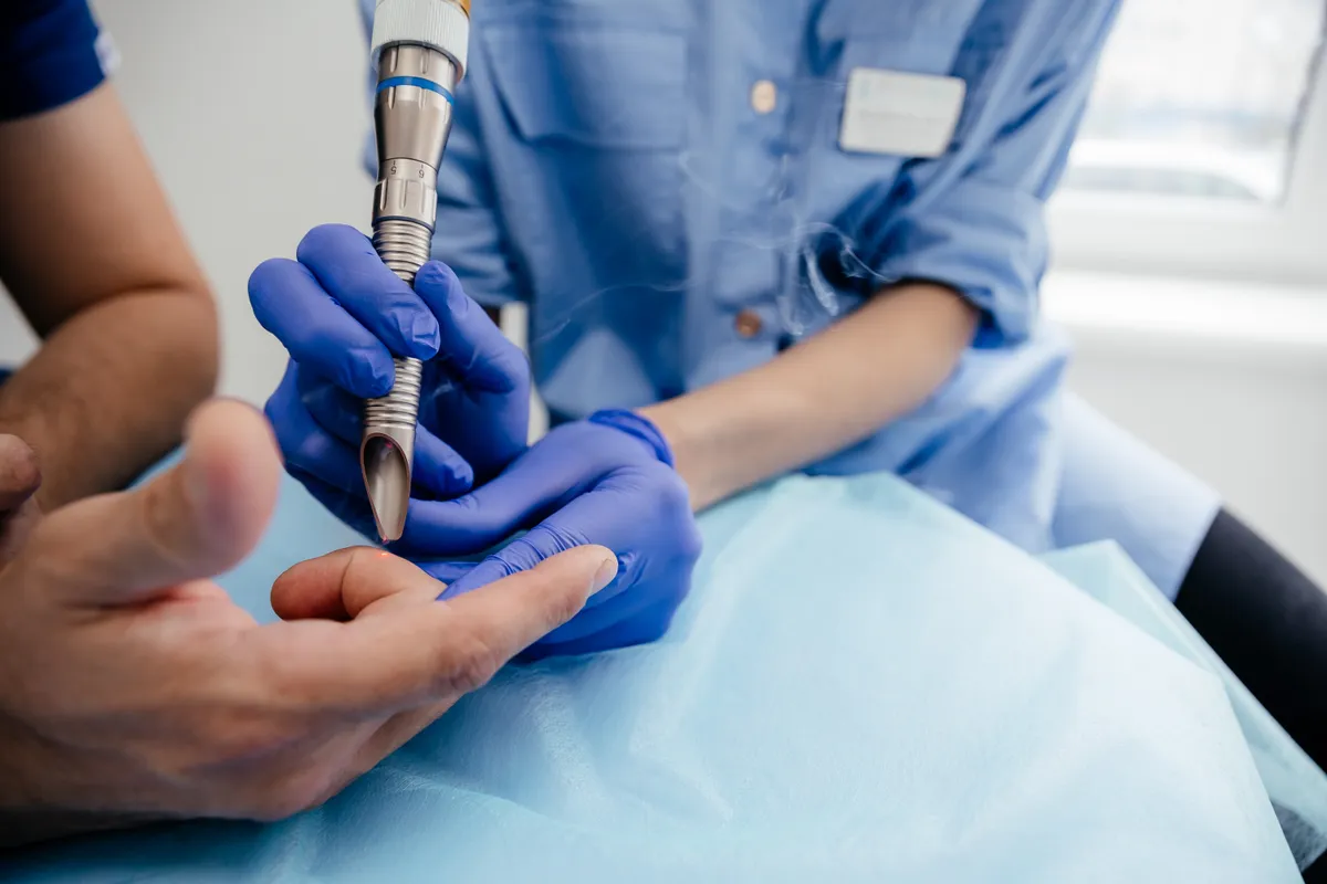 Szemölcs eltávolítása fagyasztással