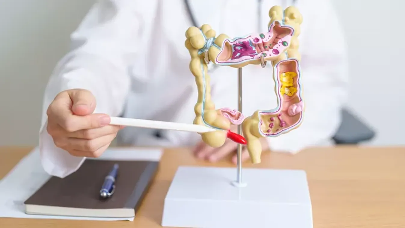 Veszélyes, mert sokáig tünetmentes: így ismerd fel a bélpolipot