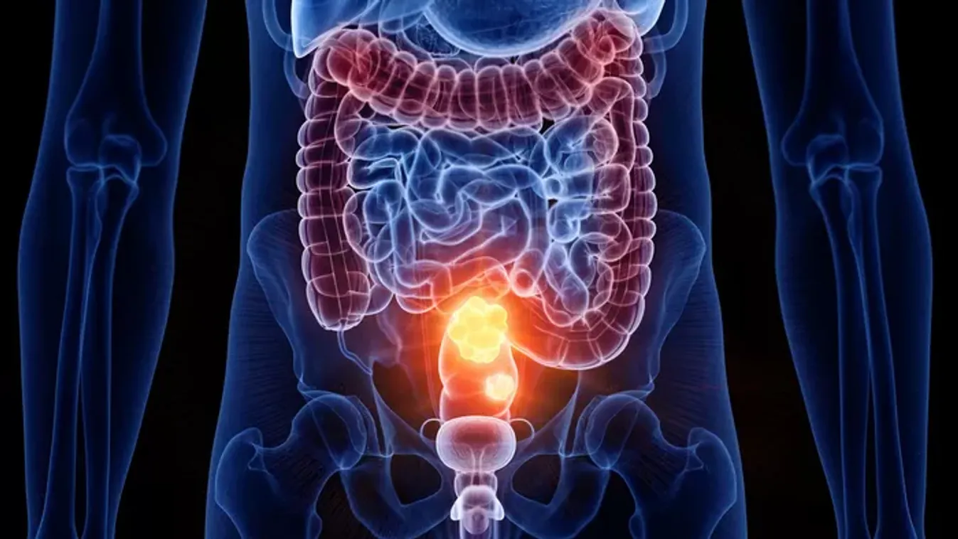 Vastagbélrák: a csendes gyilkos, amit egy egyszerű vizsgálattal megelőzhetsz