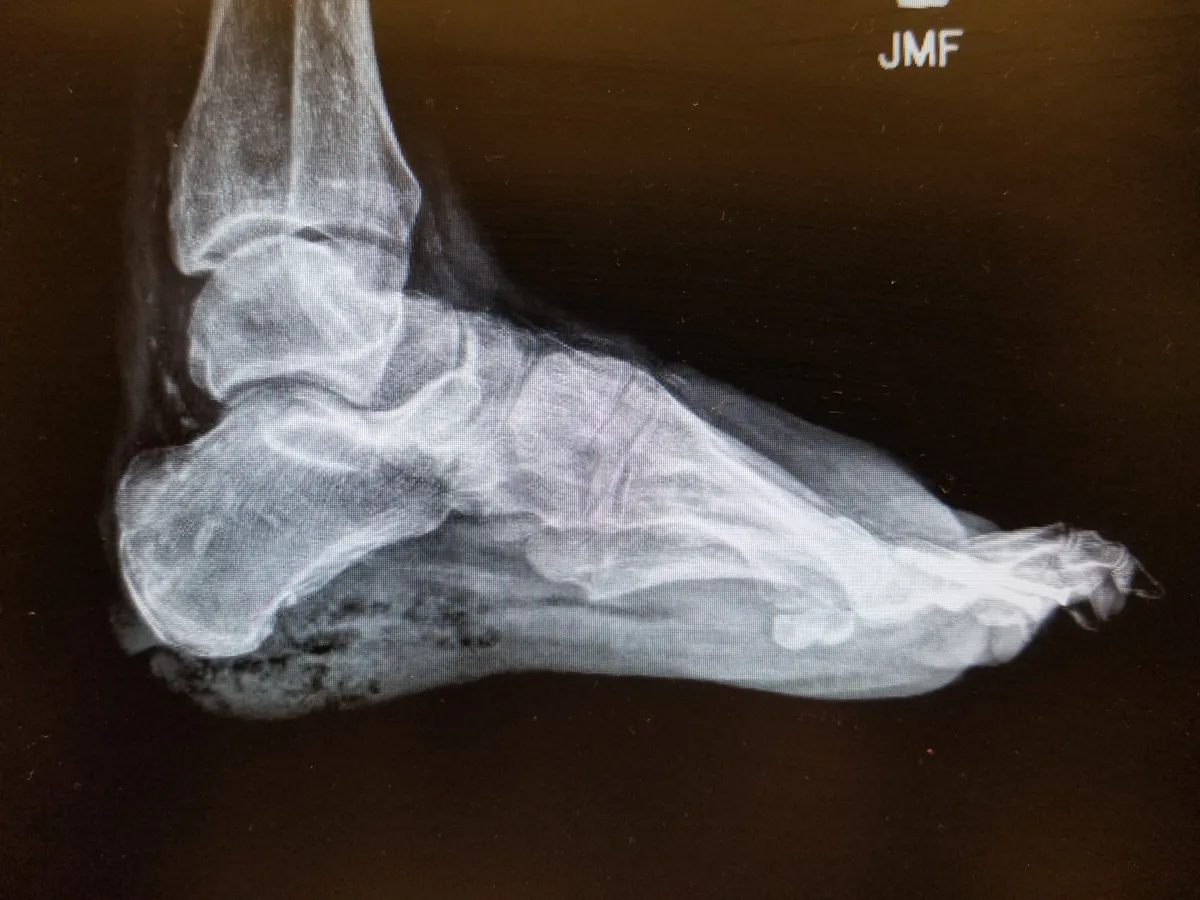 Üszkösödést bizonyító röntgenfelvétel