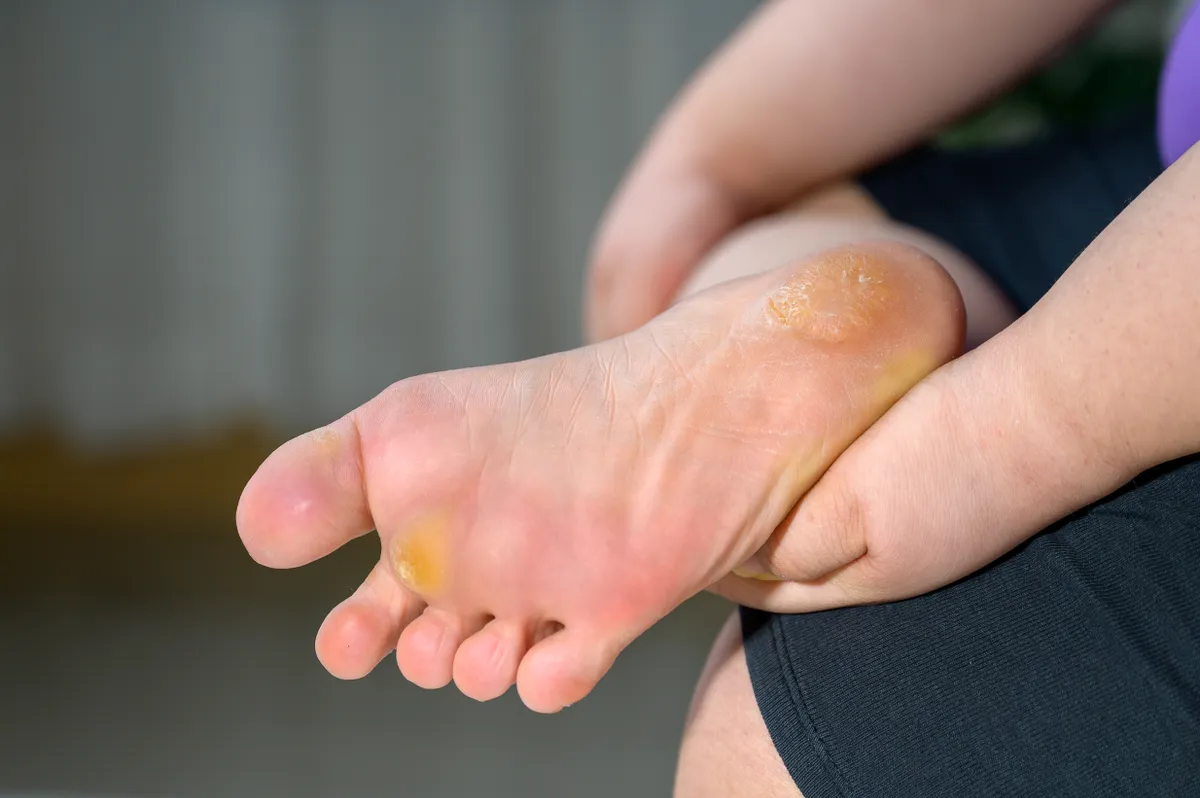 Tyúkszem és bőrkeményedések egy talpon