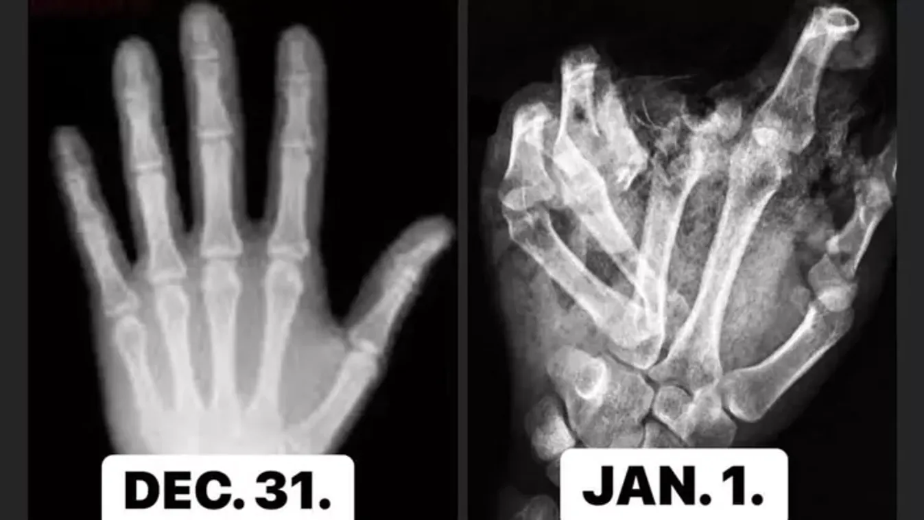 Leszakadt ujjak, szétroncsolódott kezek – erre figyelj, hogy ne legyen rémálom a szilveszteri buli