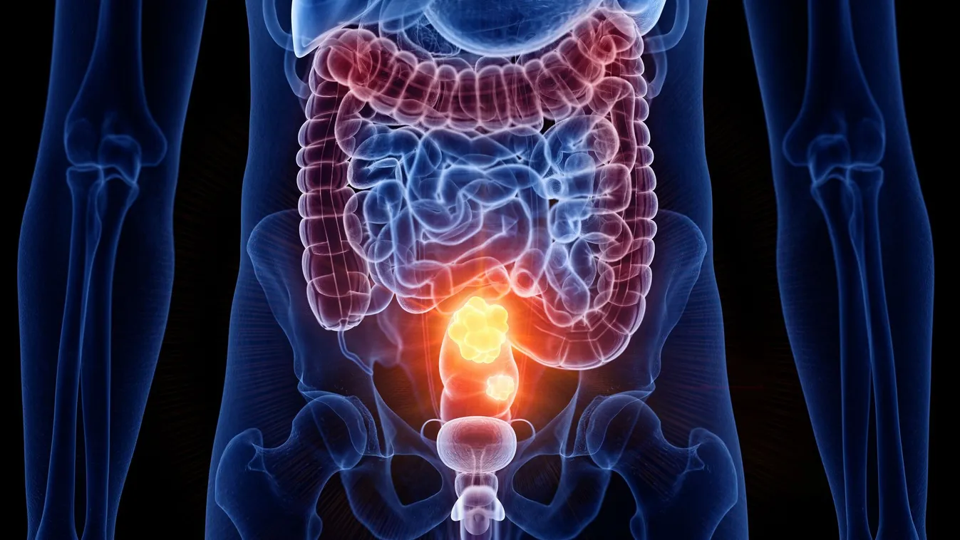 Vastagbélrák illusztrációja