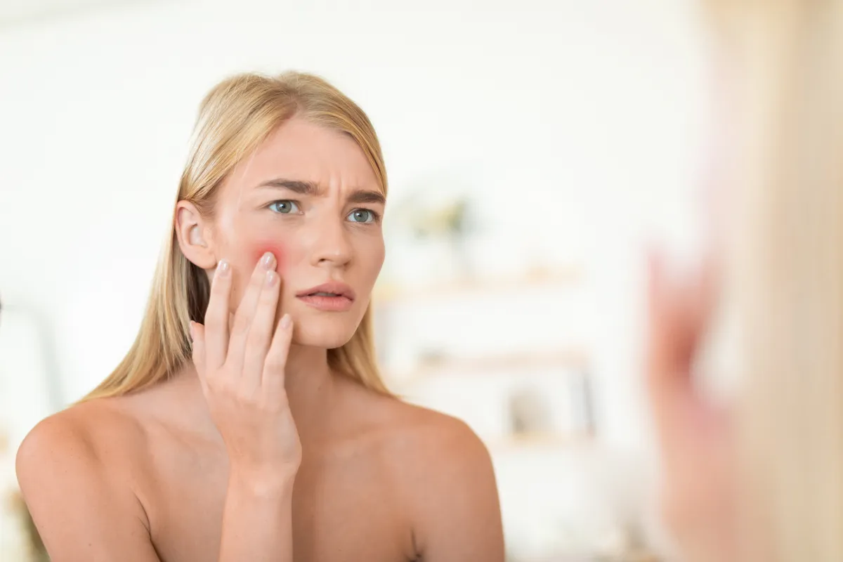Egy nő kipirosodott folttal az arcán amit a rossz bőrápolási trendeknek köszönhet.