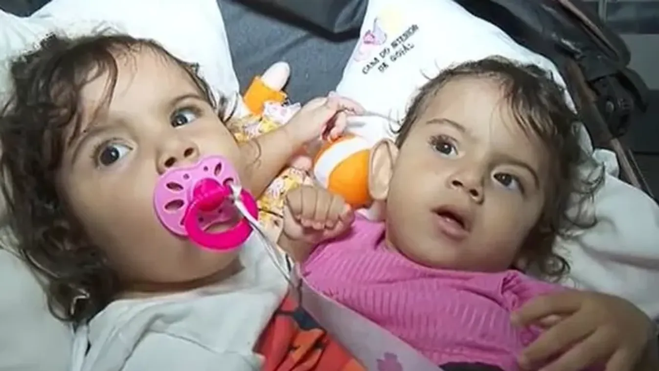 Tragikus véget ért az ikerlányok családja: hónapokkal az életmentő szétválasztó műtét után meghalt a sziámi ikerpár másik tagja is