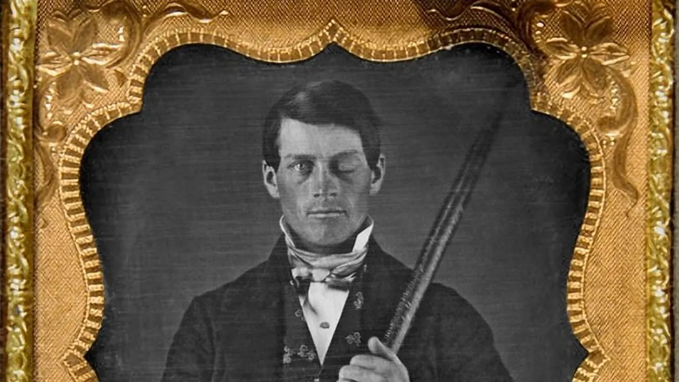 Phineas Gage és a vasrúd, ami átszakította a koponyáját. 