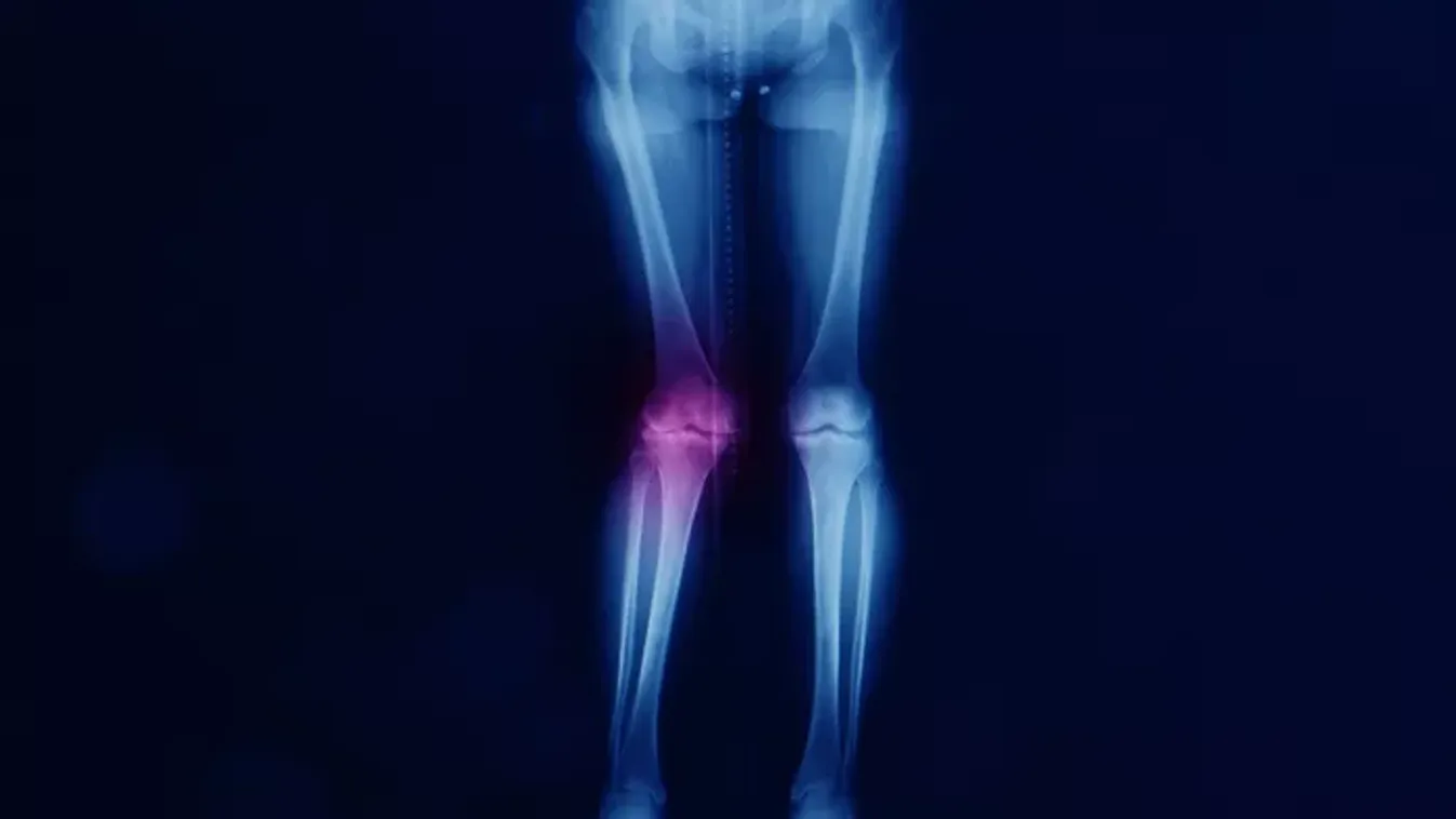 Valgus lábállás: amikor az X-lábúság több mint esztétikai kérdés