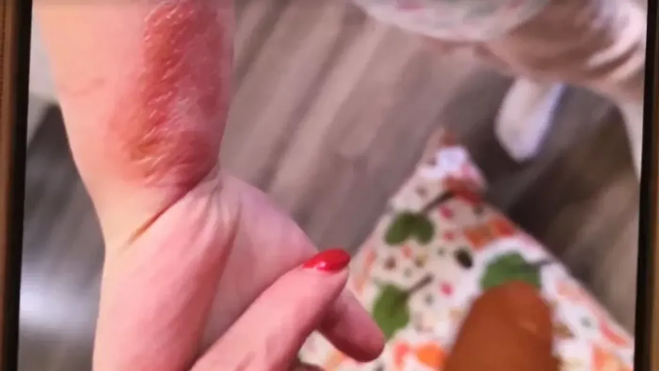 Teljesen ledöbbentek a szülők: súlyos égés sérülésekkel ment haza az óvodából a kis Hanga, kórházba kellett szállítani  – videó