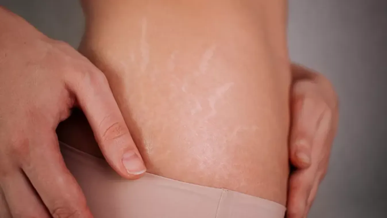 Viszlát, striák – 6 tuti módszer, amit te is kipróbálhatsz otthon