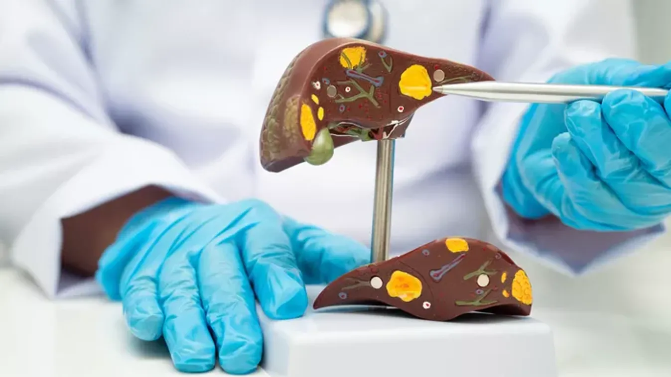 Tényleg az alkohol a hibás? Téged is utolér a zsírmáj?