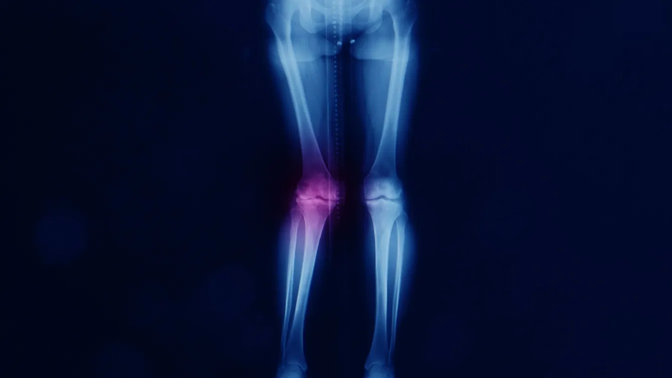 Valgus lábállás: amikor az X-lábúság több mint esztétikai kérdés