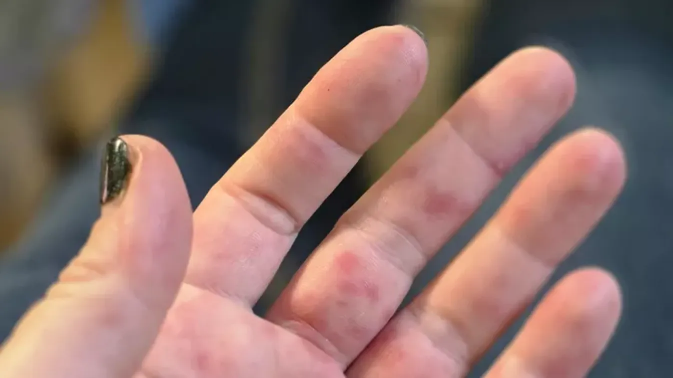 „Bármihez értem, fájt!” – Kínzó gyerekvírus terítette le Katalint és családját