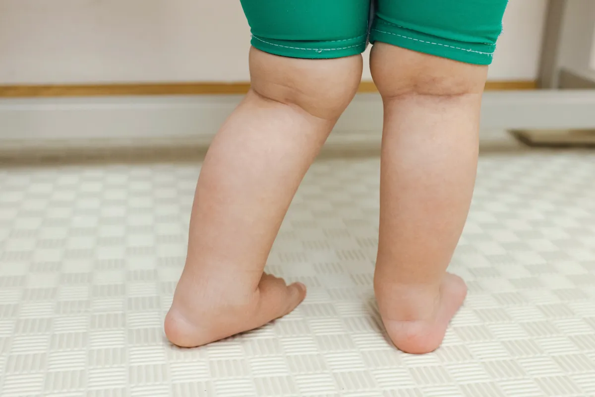 X-lábúsággal rendelkező gyerek