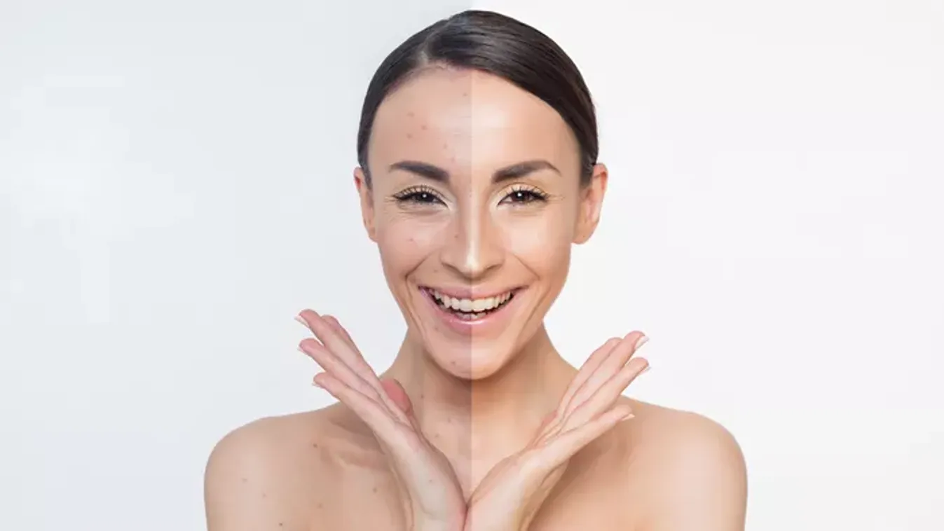 Zsírosodásra hajlamos a bőröd? Ezekkel a termékekkel tarthatod kordában