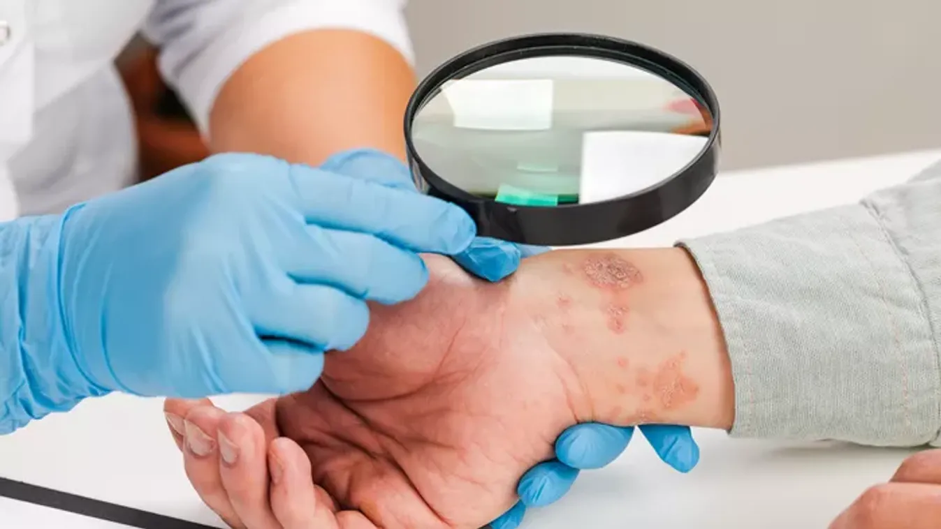 Így kezelhető a pikkelysömör a téli fellángolási időszakban