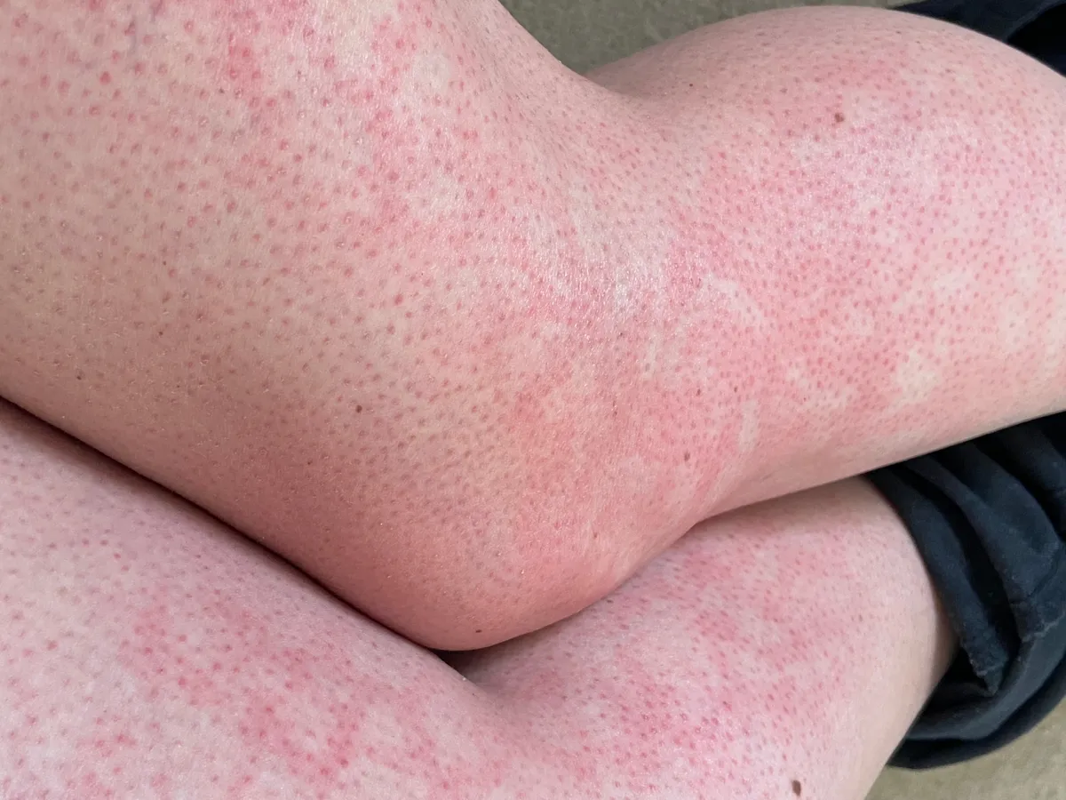 Pirított bőr szindróma egy női lábon