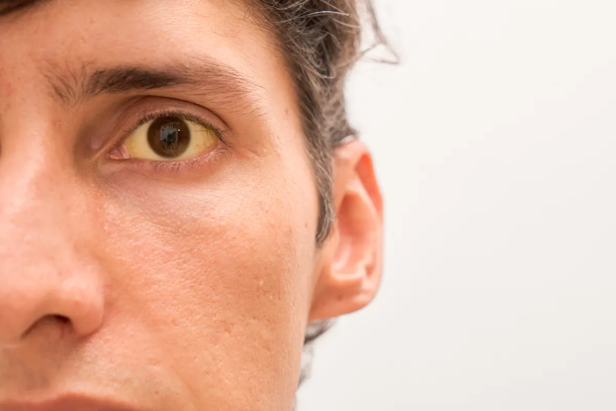 Egy férfi akinek besárgult a szeme a májgyulladástól.