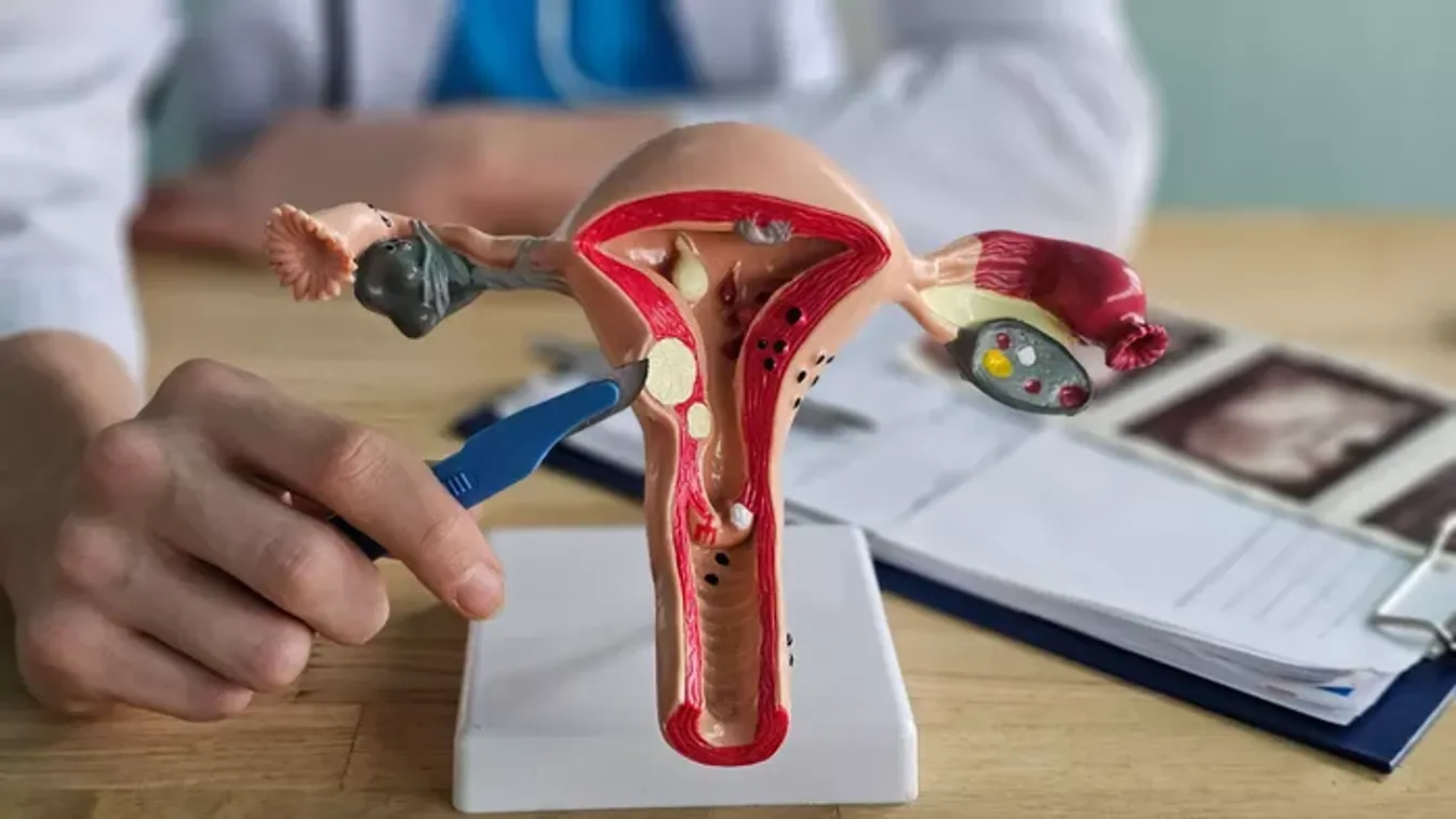 Endometriózis kezelése – Tippek és gyakorlati tanácsok