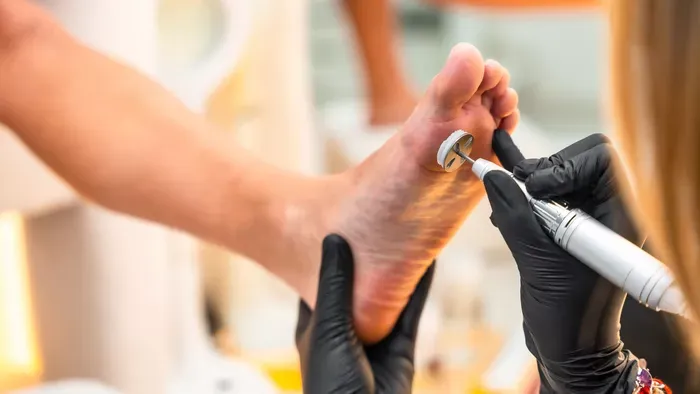 Alig találsz jó cipőt? Így szabadulhatsz meg a tyúkszemtől