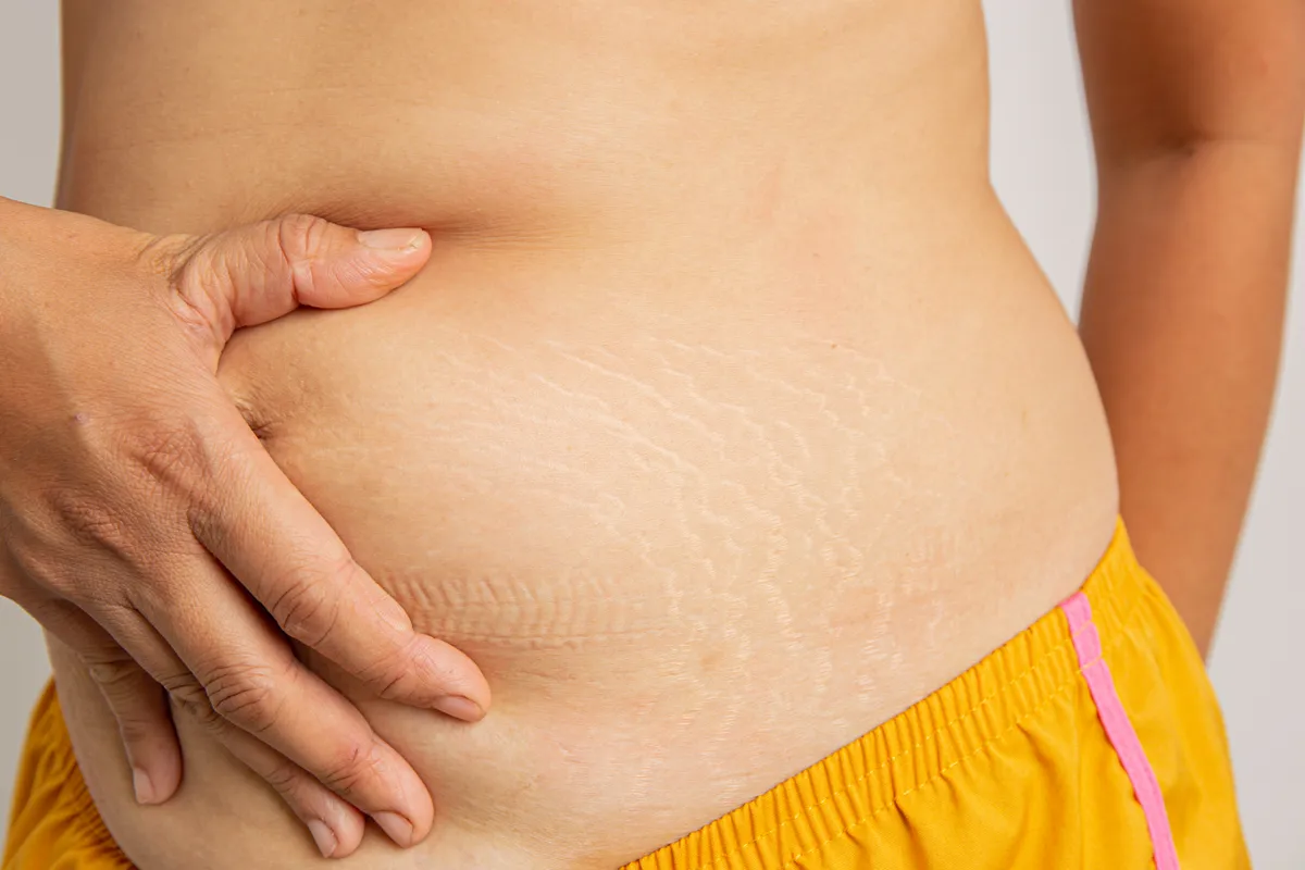 Egy nő derekán megjelenő striák a Cushing-szindróma tünetei.