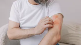 Belobbant az ekcémád a hidegben? Így tehetsz ellene