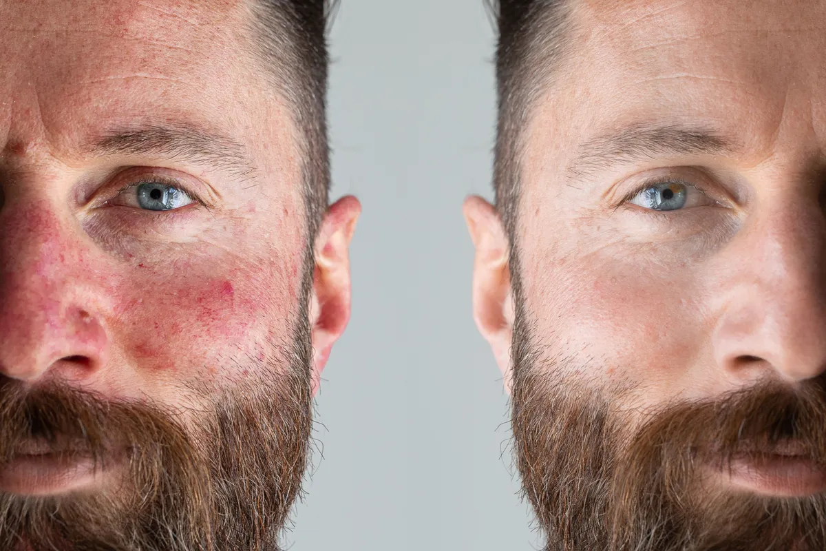 Előtte-utána kép egy férfi rosaceás, és rosacea elleni kezelés utáni arcbőréről
