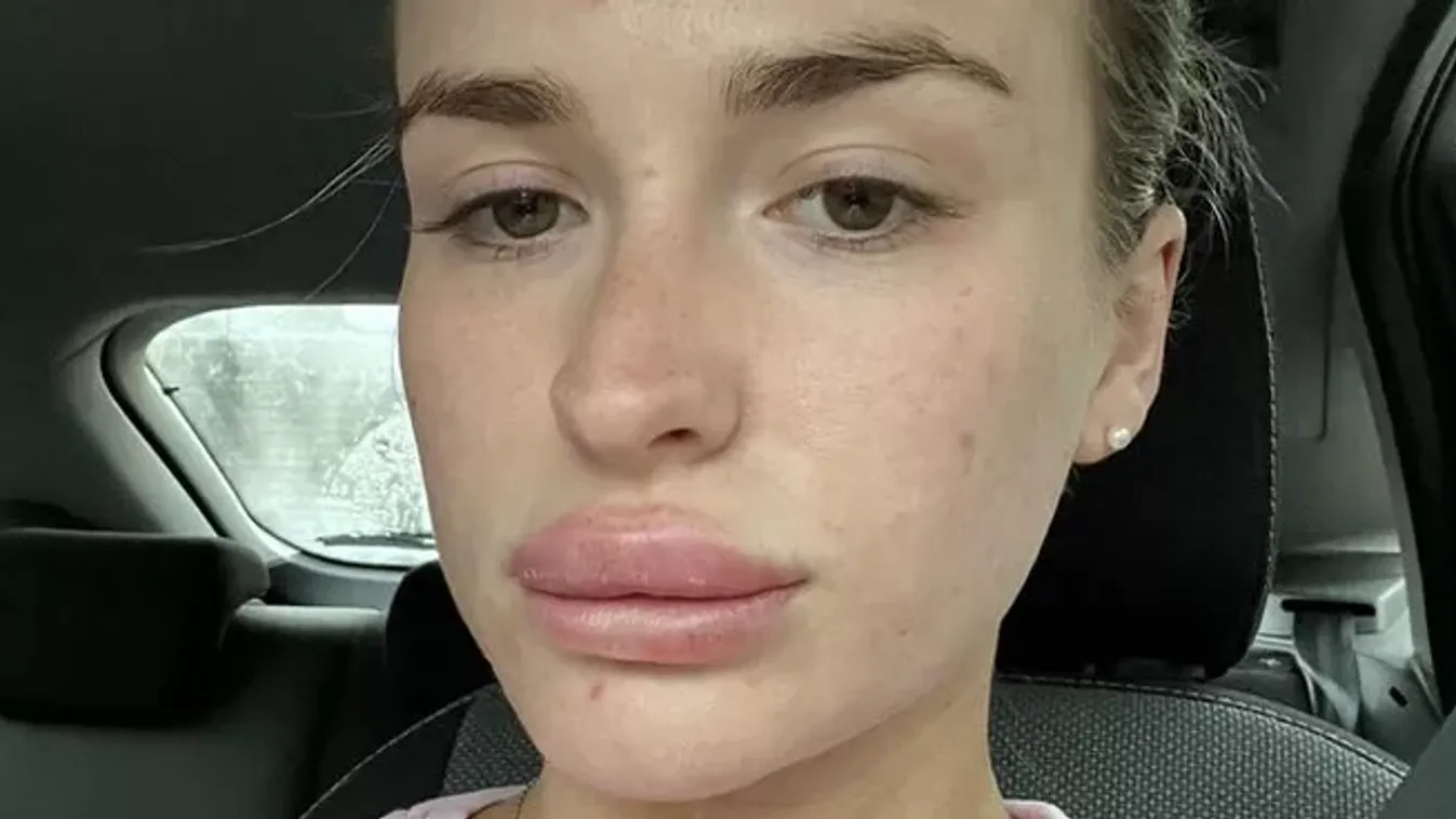 „Az orvosok nem hallgattak rám – majd hirtelen feldagadt az ajkam, és kiütések lepték el a testem”