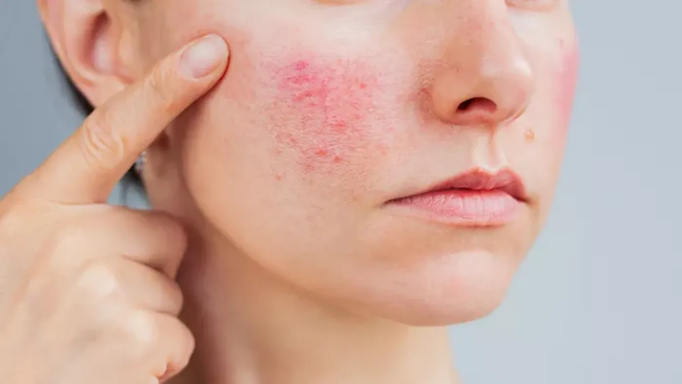 Égő, piros, gyulladt bőr: így tehetsz a rosacea ellen