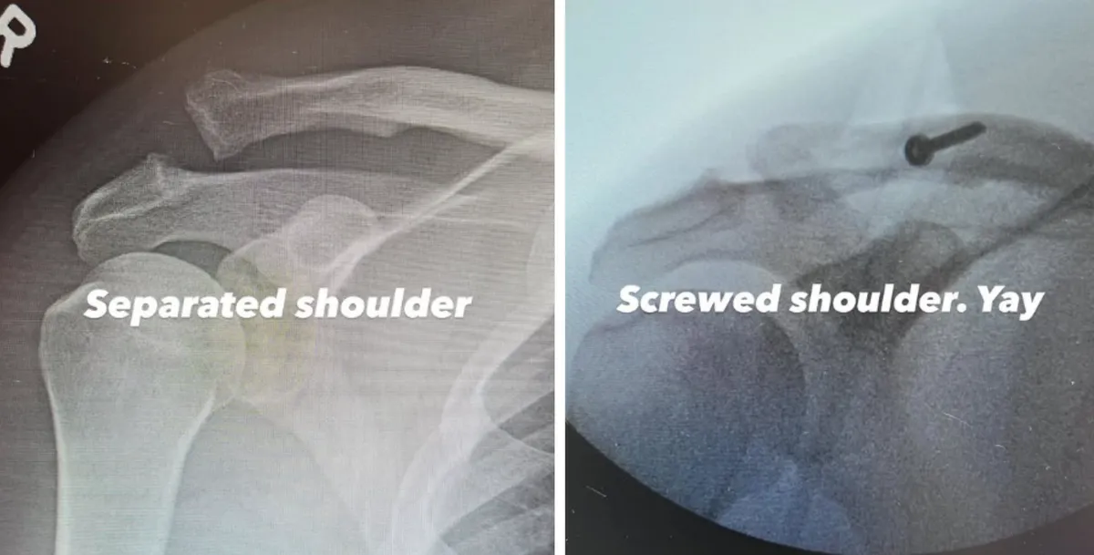 Channing Tatum vállát csavar tartja össze