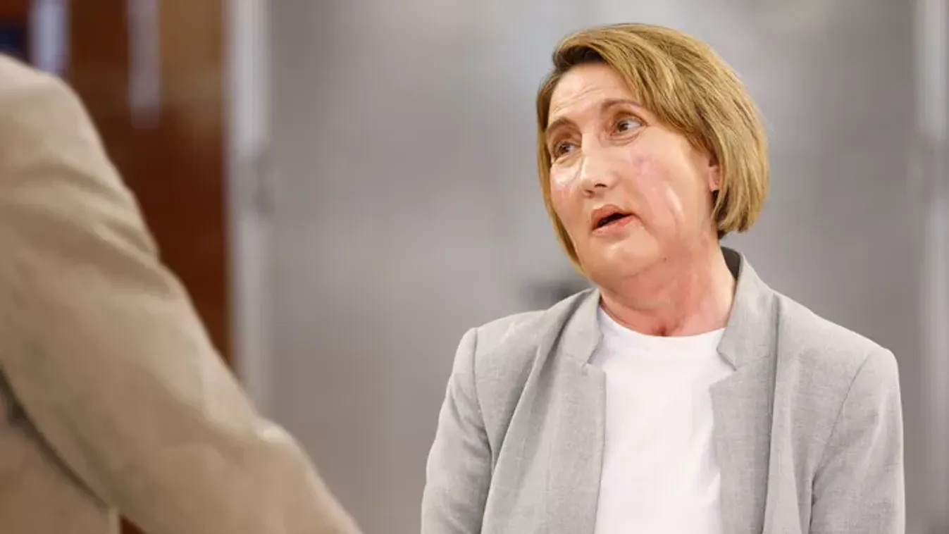 Húsevő baktérium marcangolta szét egy nő arcát: sci-fibe illő arcátültetéssel mentették meg