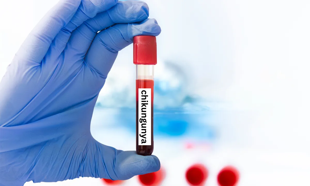 Laboros környezetben gumikesztyűben tartvalaki egy fiola vért, amire chikungunya van felírva.