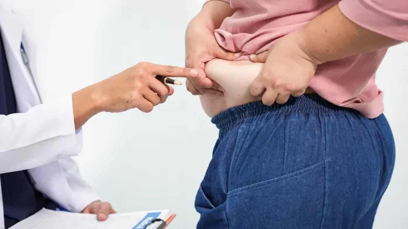 Cushing-szindróma: amikor a stresszhormon túltermelődik – Tünetek, amiket nem hagyhatsz figyelmen kívül