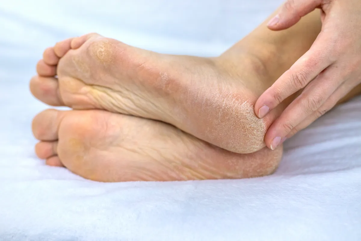 Májbetegség miatt kiszáradt, berepedezett talpbőr.