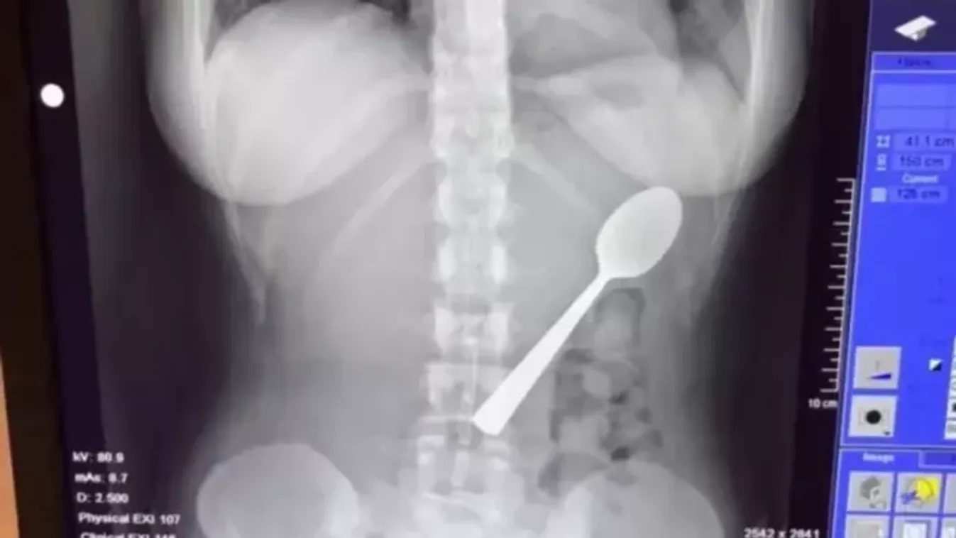 Magyar vizslája ugrott az ölébe, 17 centis kanalat kellett kiszedni a nő gyomrából