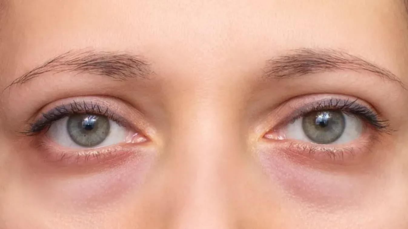 Zavar a szemed alatti duzzanat? Így enyhítheted házi praktikákkal