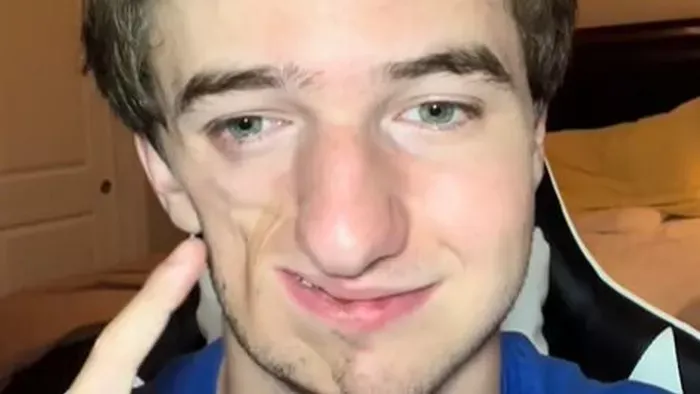 Évekig izomevő betegség ette arcát a gyermeknek