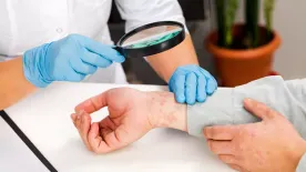 Pikkelysömör tavasszal? Így érezheted jobban magad a bőrödben