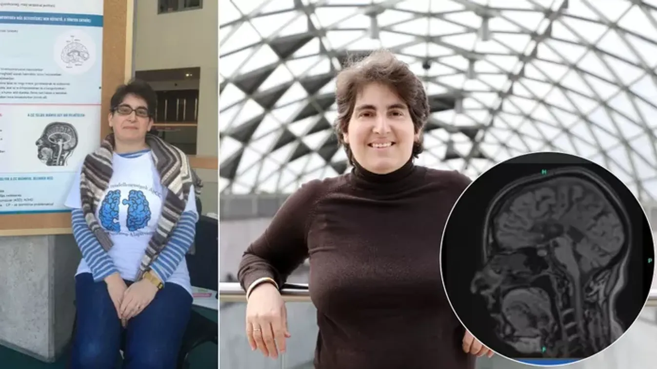 „Elképesztő nehézségekkel kellett szembenéznem”–Lyukas aggyal él Eszter