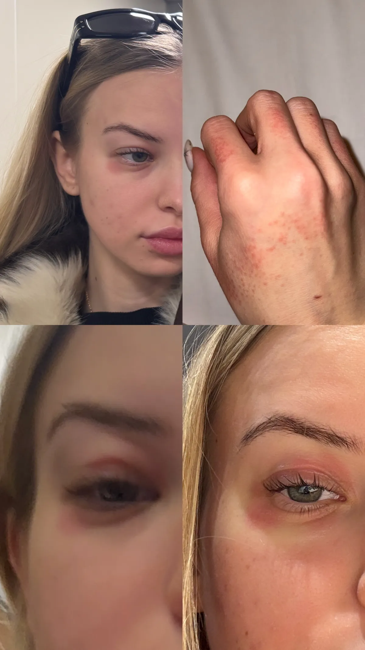 Zsigmond Angi nagyon megrémült, amikor először meglátta az arcát.